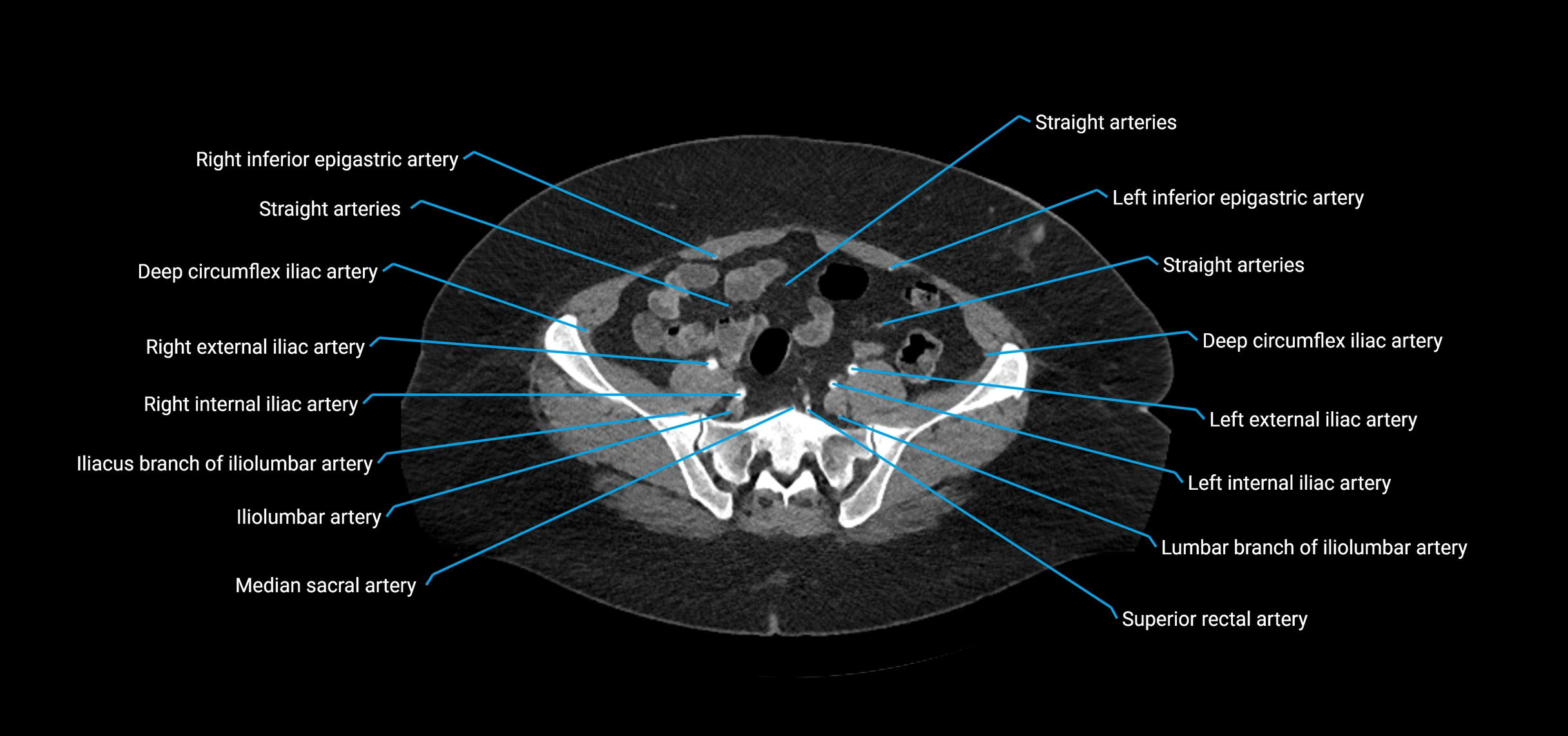 CTA abdomen axial cross sectional anatomy labelled image_188 (2).webp